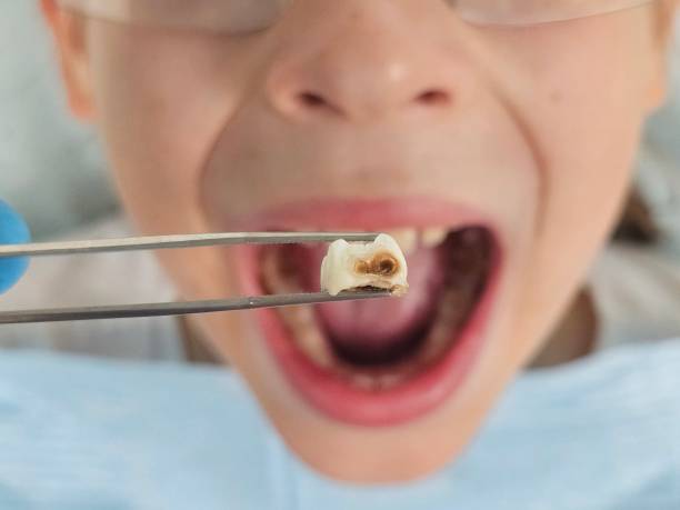 Best Emergency Cosmetic Dentistry (e.g., broken veneers) in Bonney Lake, WA