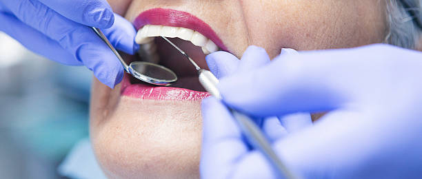 Best Knocked-Out Tooth (Avulsed Tooth) Treatment in Bonney Lake, WA